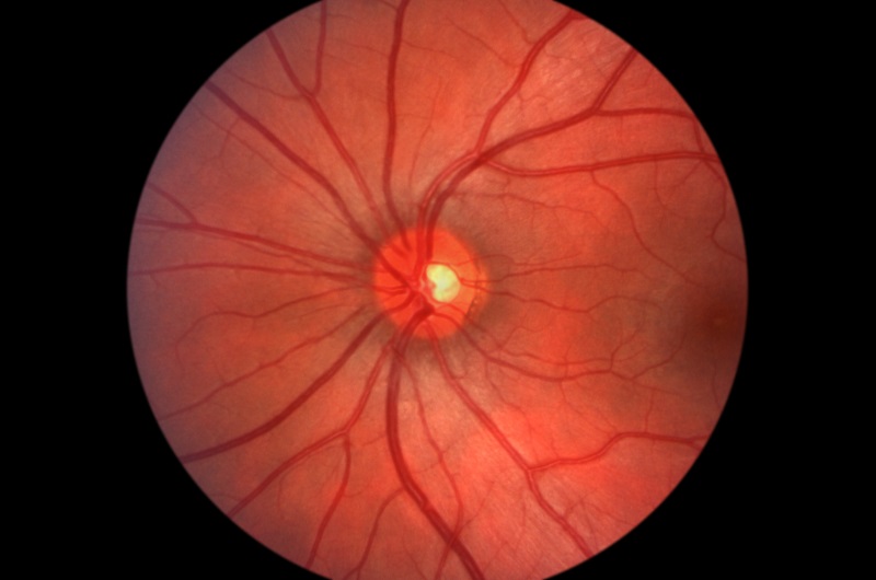Glaucoma Eufaula, AL 
